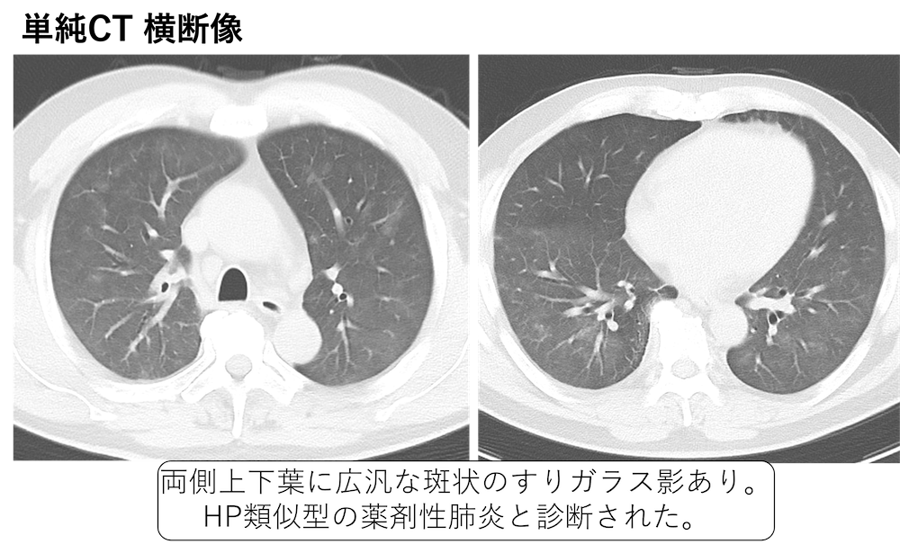 今季一番 CTパターンから理解する呼吸器疾患 所見×患者情報から導く 